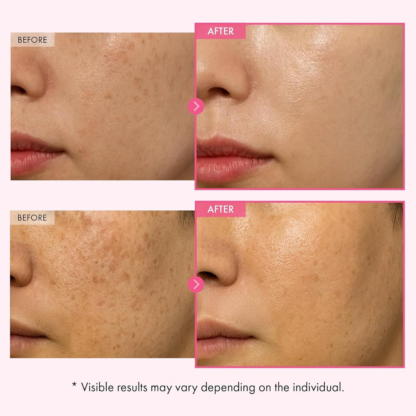 Crema Coreana Aclarante — Elimina Manchas y Marcas de Acné